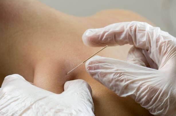 Find Effective Relief for Your Pain with Dry Needling