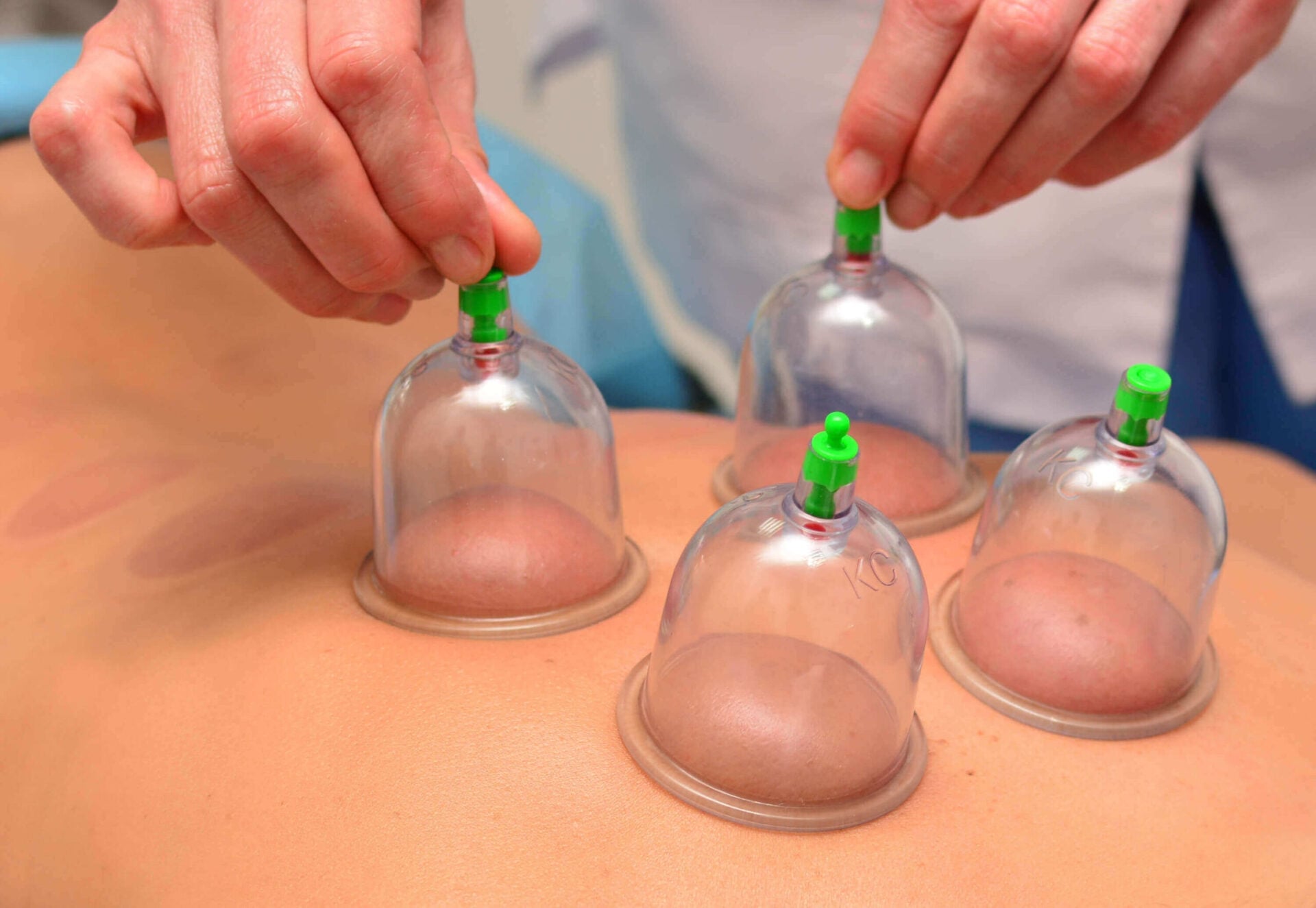What is Cupping?