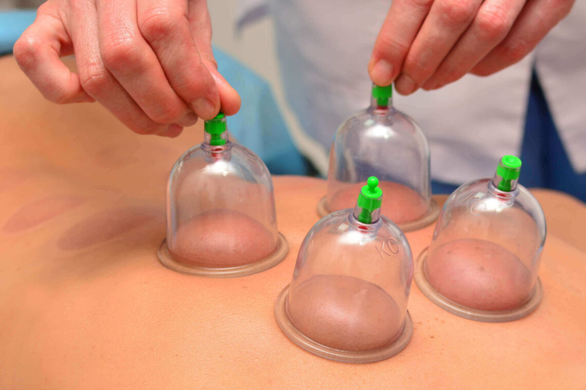 cupping